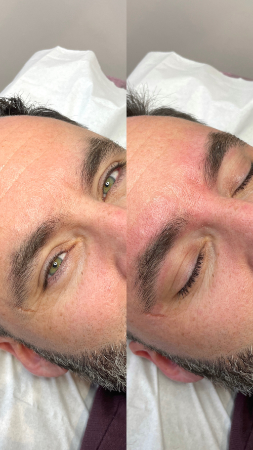 RestructurationEpilation5