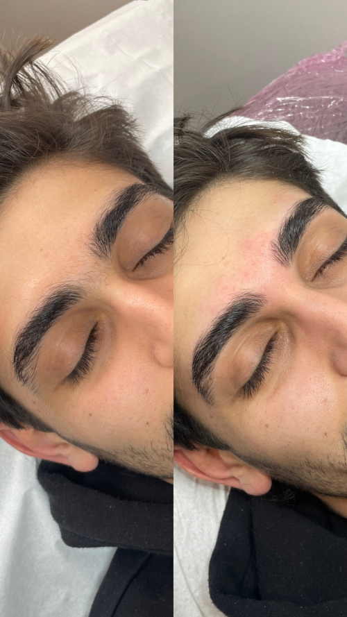 RestructurationEpilation6