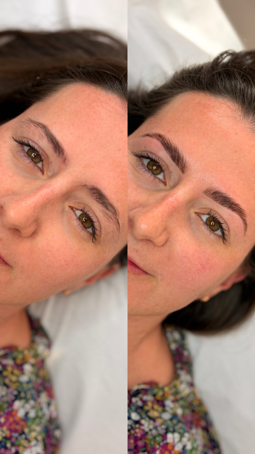 browlift1