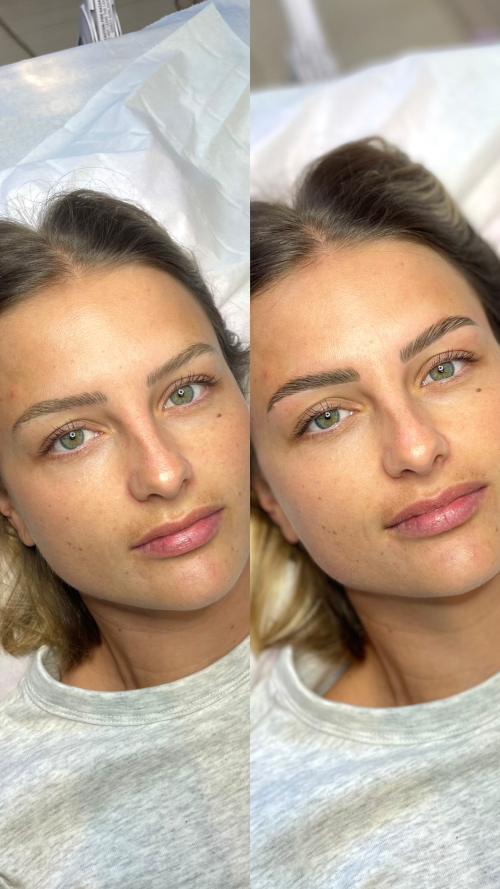 browlift2