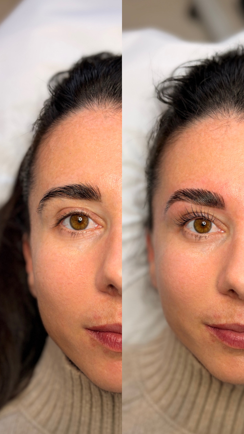 browlift3