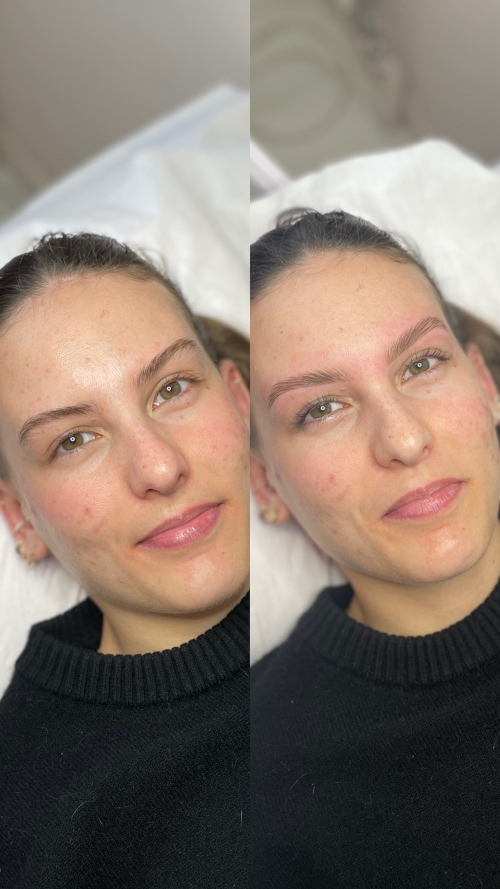 browlift4